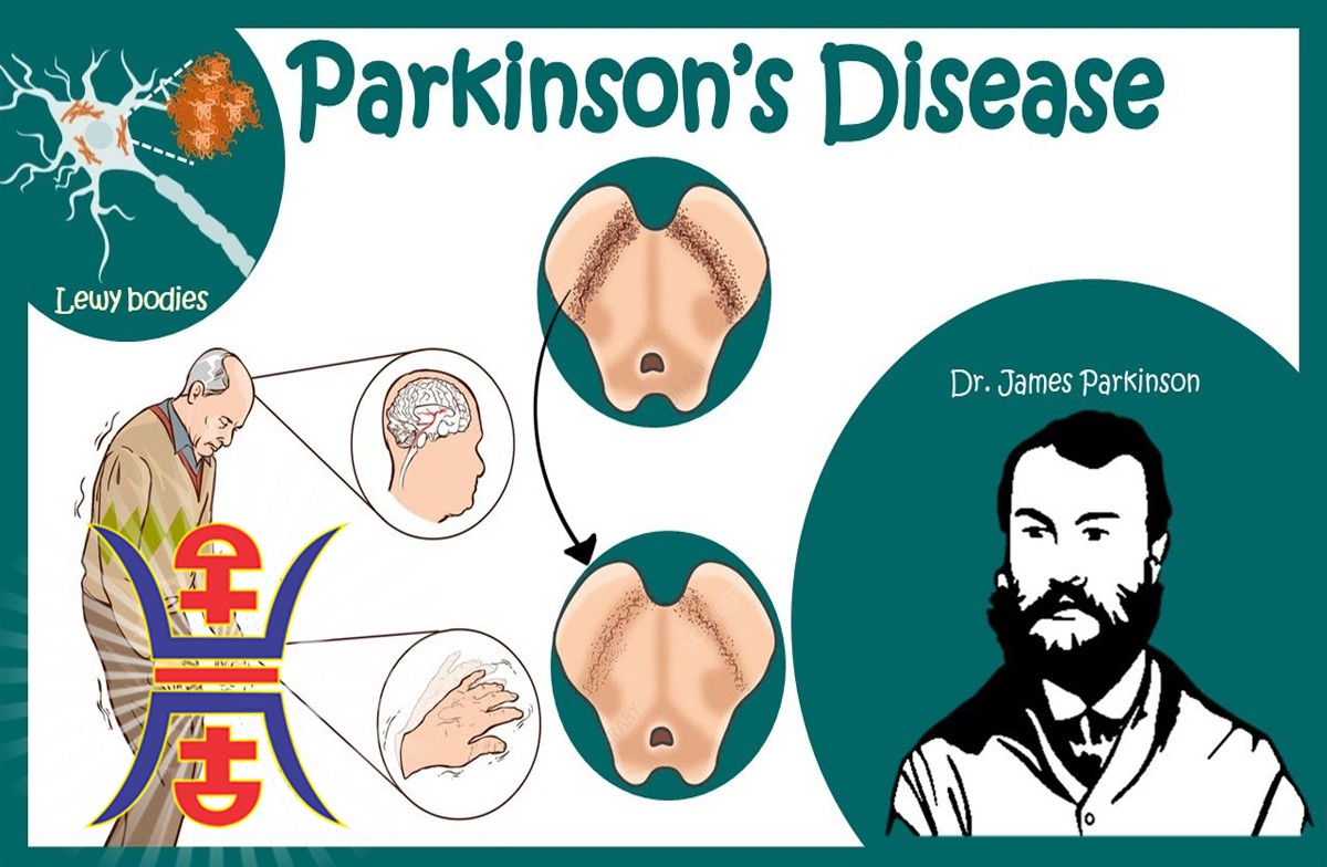 parkinson