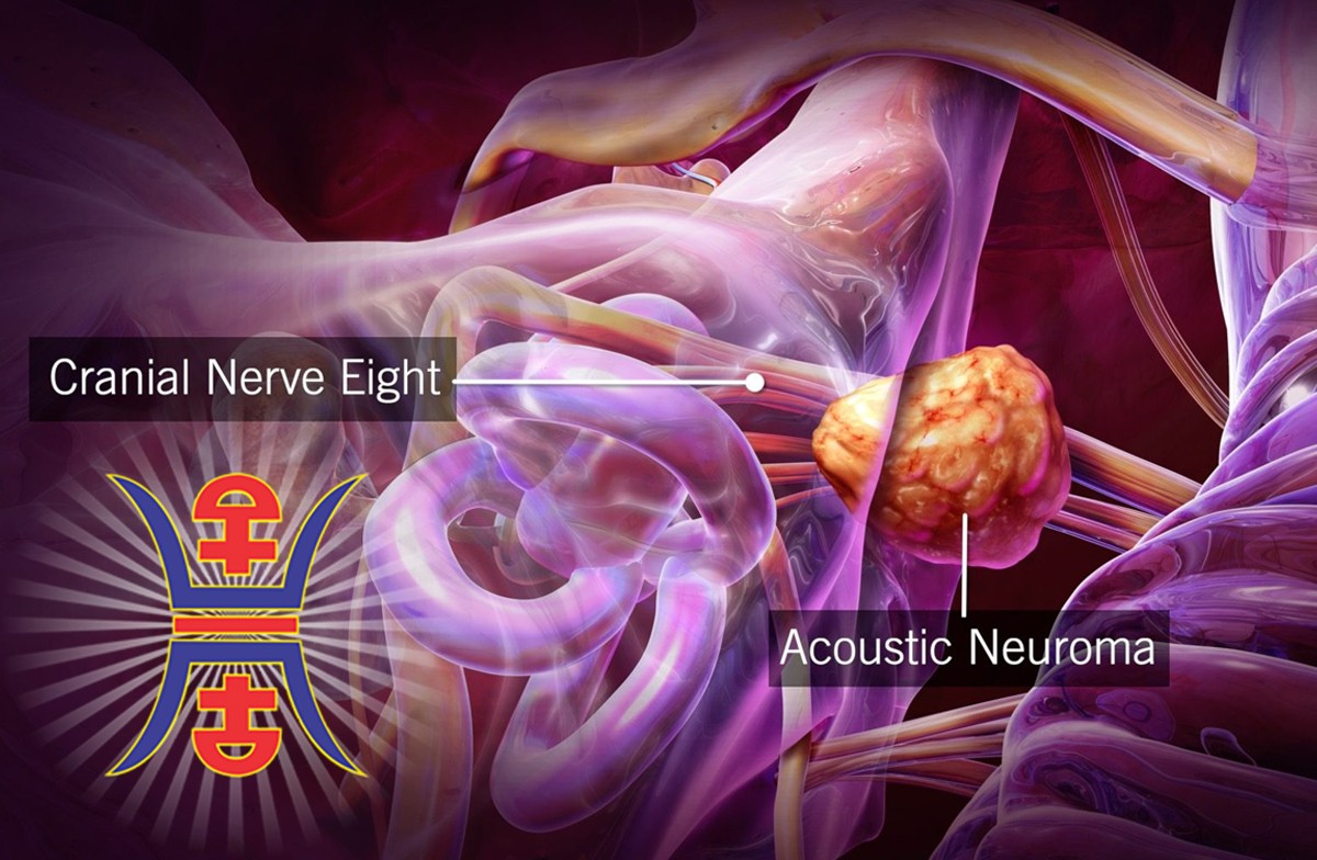 Acoustic-Neuroma