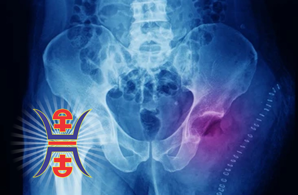Chondrosarcoma