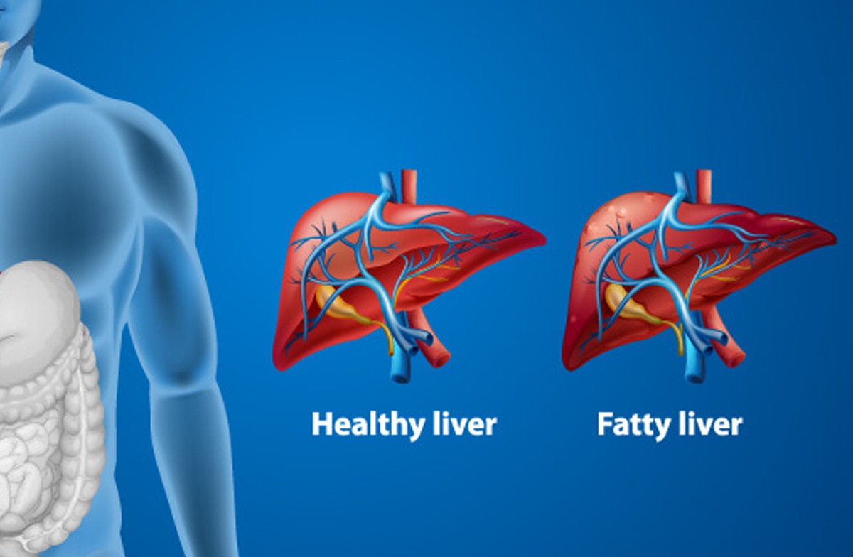 fatty-liver