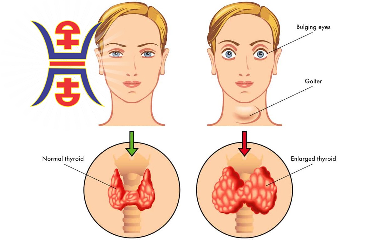 hyperthyroidism