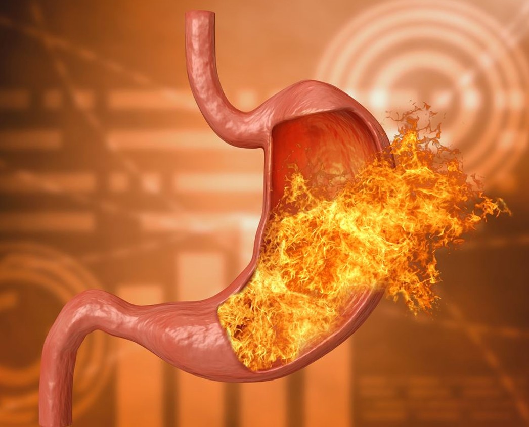 acid-reflux