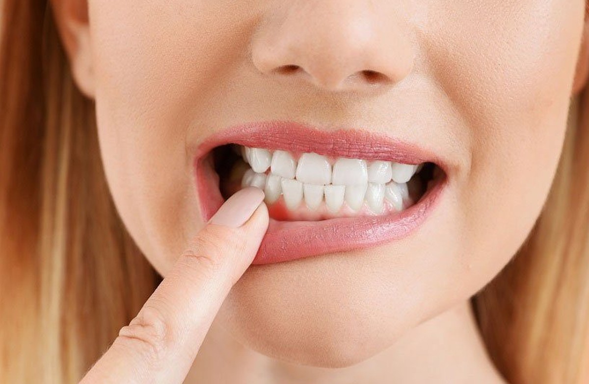bleeding-gums