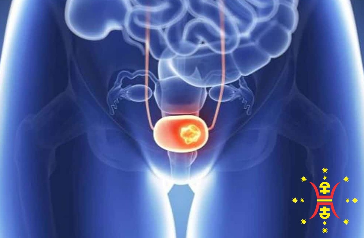 Bladder-Cancer