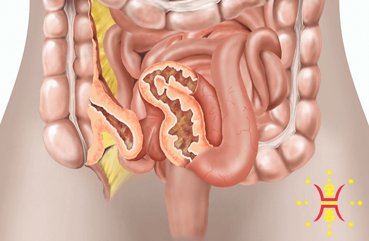 Crohns-Disease