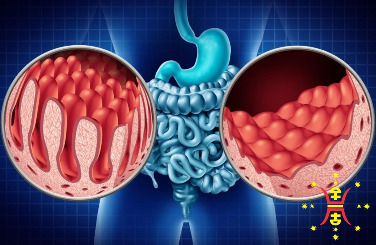 Celiac-Disease