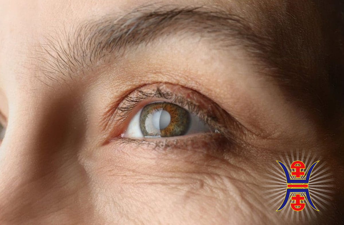 Cataracts In Traditional Chinese Medicine