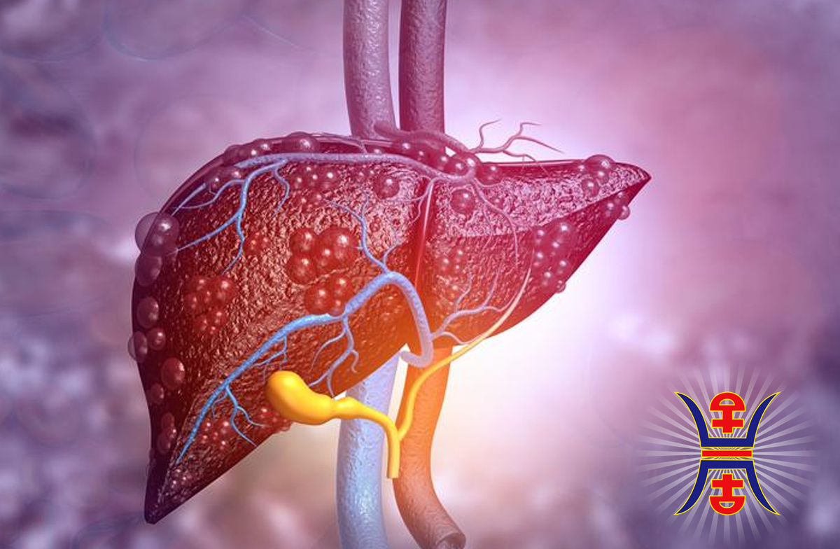 Liver Cirrhosis in Traditional Chinese Medicine: Causes, Symptoms, and Holistic Treatment Approaches